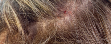 inflammation i hovedbunden