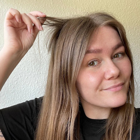 Frederikkes historie: alopecia og hårgenvækst